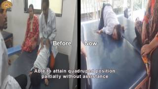 Dystonic Cerebral Palsy Treatment Results  Quick Look  No 3112 [upl. by Nairdna431]