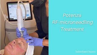 Potenza RFmicroneedling [upl. by Sidoon]