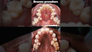 Crowded teeth treatment trendingshorts viralvideo Drswetakaushik braces procedure [upl. by Trauts17]