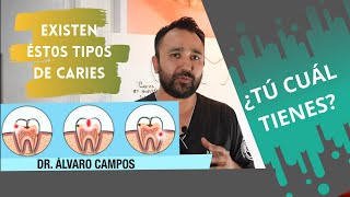 ¿Qué tipos de caries existen  Dr Alvaro Campos [upl. by Iur937]