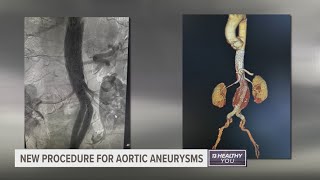 West Michigan man has new procedure to treat aortic aneurysm first in state [upl. by Fem363]