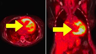 Young Man Takes BrandNew Vitamin K2 Supplement This Happened To His Heart [upl. by Ayokahs466]