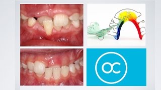 Interceptive Orthodontics At The Orthodontic Centre Palmerston North [upl. by Madriene]