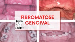 Fibromatose Gengival  Resumos de Odonto [upl. by Shig]