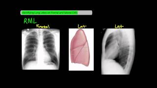 Identifying Lung Lobes on Frontal and Lateral Chest XRays UndergroundMed [upl. by Nevada]