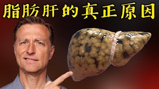 脂肪肝的真正原因自然療法柏格醫生 Dr Berg [upl. by Itnaihc414]