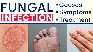 ✅ Fungal Infection क्या और कैसे होता है ✅ Fungal Infection Symptoms Causes and Treatment in Hindi [upl. by Herta]