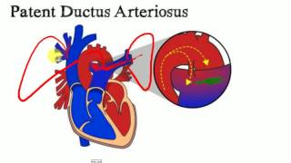 PEDIATRICS LECTURES  Cardiology  PATENT DUCTUS ARTERIOSUS [upl. by Petromilli]