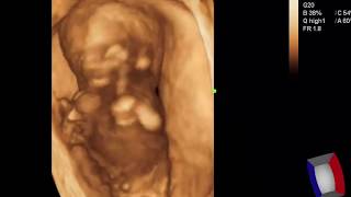 CASE 373 2D 3D 4D FETAL PHOCOMELIA MEROMELIA [upl. by Dawaj]