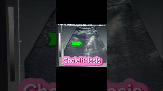 Stones in GB  Cholelithiasis  Cholecystitis  Gallstones  Fatty liver on Ultrasound [upl. by Ddet]