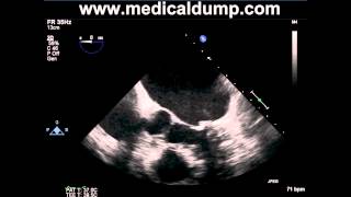 Left Atrial Appendage Thrombus  TransEsophageal Echocardiogram TEE [upl. by Mose478]