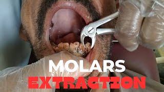 Lower Molars Extraction  molar extraction  molars teeth removal [upl. by Sigfrid]