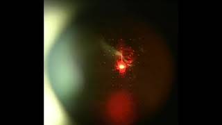 Eye Floater Laser Vitreolysis Patient of Scott Geller MD [upl. by Farny991]