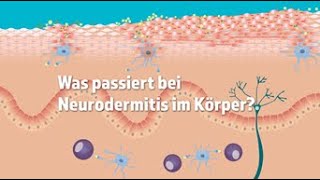 Was passiert bei Neurodermitis im Körper [upl. by Newell]