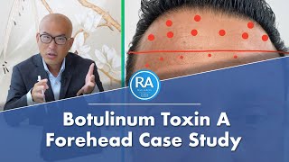 Botox Forehead on Man  Botulinum Toxin A Injections Case Study [upl. by Initof]