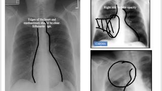 Structured Interpretation of Chest Xray [upl. by Nivek]