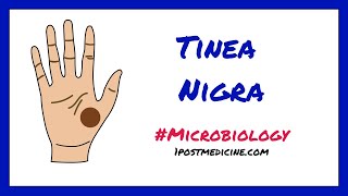 Tinea Nigra  Microbiology [upl. by Estey]