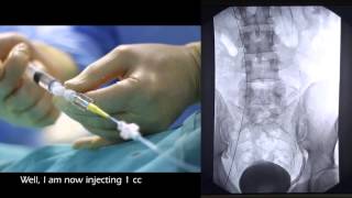 Embolization of varicocele 2 more treatments [upl. by Euginom]