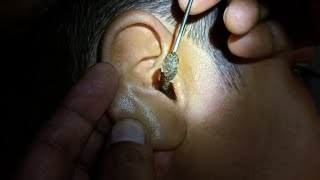 Fully blocked Ear Wax Removal [upl. by Bohannon]