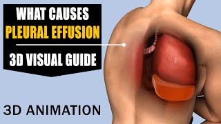 Pleural Effusion Explained Causes Symptoms Diagnosis and Treatment pleuraleffusion [upl. by Mor57]