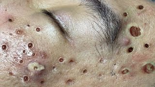 Loan Nguyen Acne Treatment 79b [upl. by Ivory607]