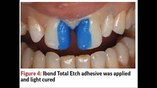 Diastema closure full case  A to Z [upl. by Gerek]