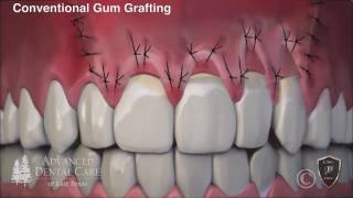 Correcting Receding Gums through Pinhole Surgery [upl. by Kavita]