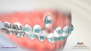 Orthodontic Treatment for Impacted Canine  Laser Exposure [upl. by Ykroc]