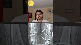 knee cartilage homoeopathy treatment [upl. by Olenka]