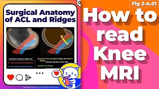 Fig 2A01 Surgical Anatomy of ACL and Associated Ridges [upl. by Tapes638]