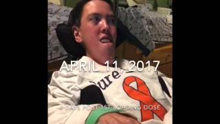 Danny McHales Spinraza Journey [upl. by Lovmilla]