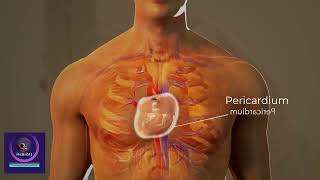 Cardiac Tamponade Treatment  Cardiac Surgery Procedure 3D Animation [upl. by Eastlake954]