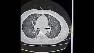 Pneumocystis jirovici pneumonia [upl. by Ellegna]