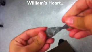 Amplatzer Septal Occluder Successfully Seals Hole In William Blanco Mays Heart [upl. by Saint]