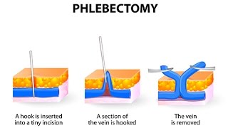 Comment soigneton une phlébite [upl. by Worthy]