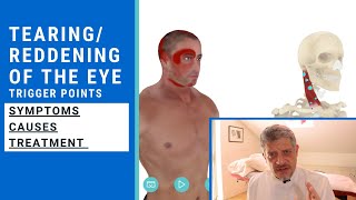 TearingReddening Eye  Trigger Point of the Week [upl. by Damal306]