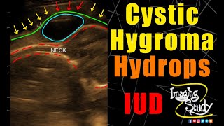 Cystic Hygroma  Hydrops Fetalis  Ultrasound  Anomaly  Case 214 [upl. by Laws]