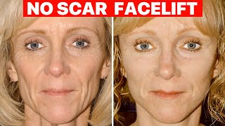 Scarless Facelift  Plastic Surgeon Explains [upl. by Antony]