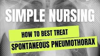 Best Treatment for Spontaneous Pneumothorax [upl. by Assirrak993]