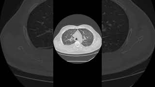 Bilateral pleural effusion [upl. by Chrystel]