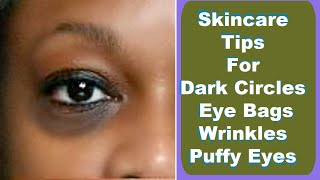 Dark Circles Eye Bags Puffy Eyes Wrinkles And Crows Feet Tips [upl. by Yenahpets]