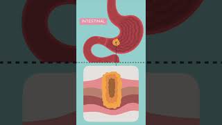 Stomach cancer Types and progression  Kenhub shorts [upl. by Ennairrac]