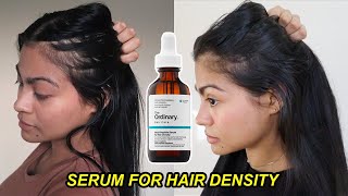 I tried The Ordinary Serum for Hair Density for 4 months amp THIS HAPPENED  Before and after results [upl. by Koslo]