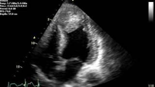 Large Apical Echo Density [upl. by Nagar]