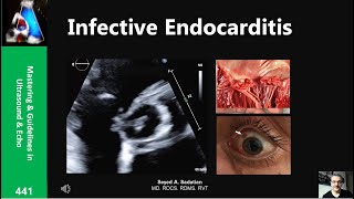 Infective Endocarditis  public [upl. by Lauter]