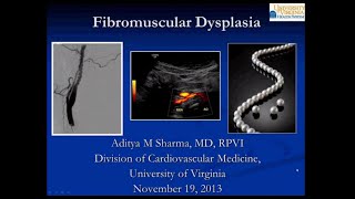 SIRRFS Webinar 111913 Fibromuscular Dysplasia [upl. by Novets413]