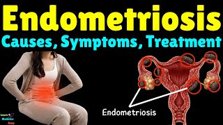 Endometriosis Causes Symptoms Diagnosis Treatment Complications amp Prevention [upl. by Dulcie]