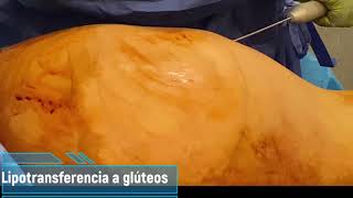 Lipotransferencia a glúteos [upl. by Denae]