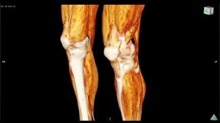 Legs patellar tendon 脚、膝蓋腱 volume rendering 3D CT [upl. by Annaet933]