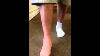 Gait Status Post Triple Arthrodesis Surgery for PTTD Flatfoot SFISM [upl. by Aimit]